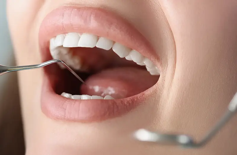 Esztétikus fogtömés Poncz Dental Budapest Esztétikus fogtömés Poncz Dental Budapest